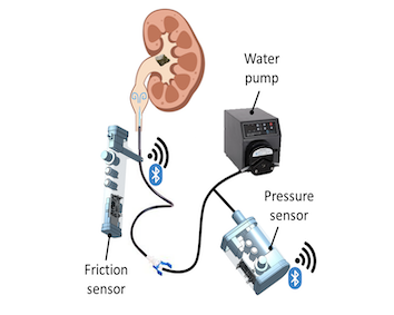 Medical device (ureter)
